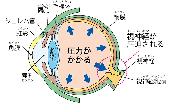 角 隅 緑内障 閉塞 急性